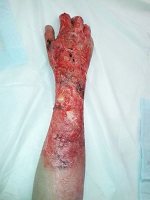 Image: Verbrennung an Hand und Unterarm