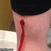 Image: Schusswunde am Arm mit pulsierende Blutung