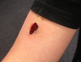 Image: Schusswunde am Arm (mit Blutpumpensystem)